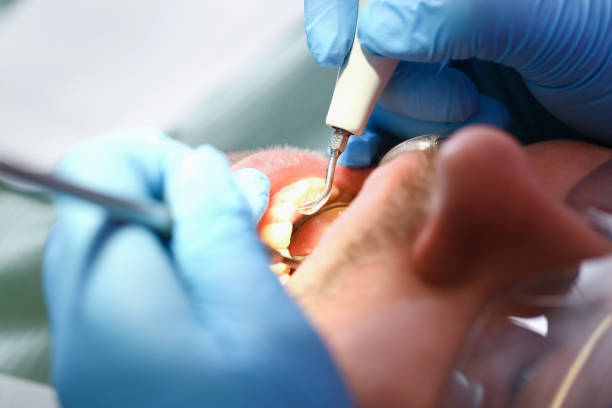 Best Emergency Treatment for Dental Infections or Abscesses in Rock Springs, NM